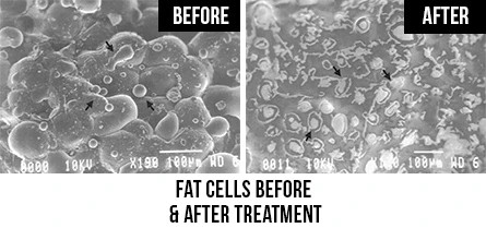 Chiropractic Rock Hill SC Fat Cells Before and After
